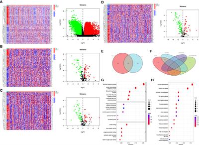 The prognosis of bladder cancer is affected by fatty acid metabolism, inflammation, and hypoxia